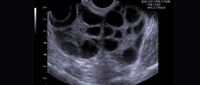 Your Top Questions About PCOS Answered